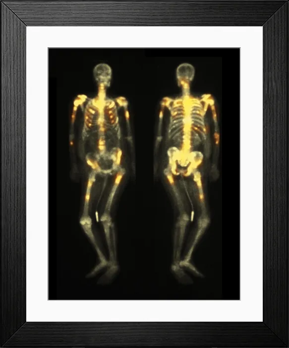 Framed Print : Bone scan showing multiple metastases Framed Print : Bone scan showing multiple metastases