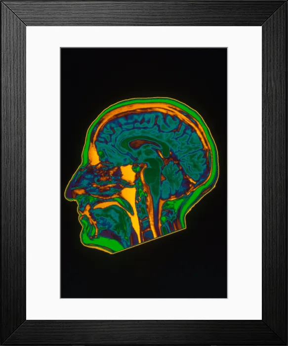 Framed Print : Brain MRI. MRI scan of normal brain