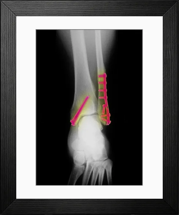 Framed Print : Fractured Ankle With Screws and Plates