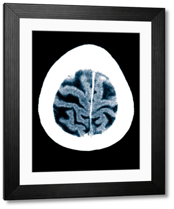 Framed Print : Brain of Alzheimer's Patient, CT Scan