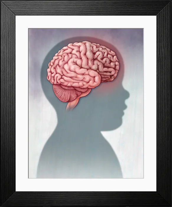 Framed Print : Tay-sachs Disease, Brain Anatomy Framed Print : Tay-sachs Disease, Brain Anatomy