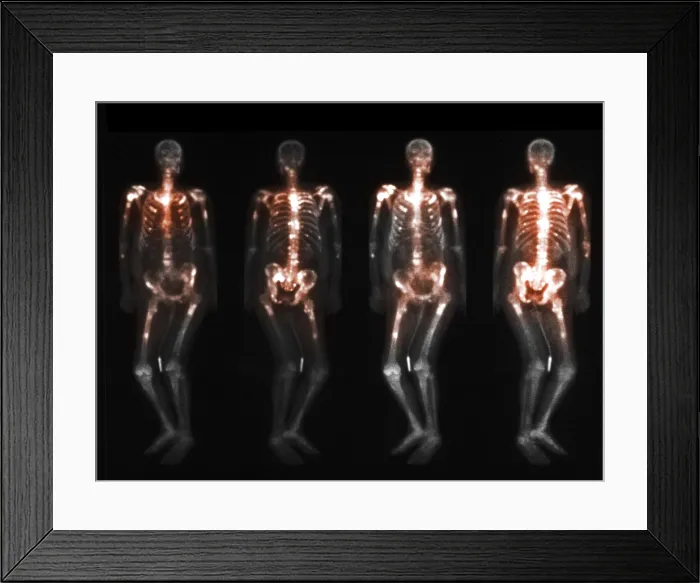 Framed Print : Bone scan showing multiple metastases Framed Print : Bone scan showing multiple metastases