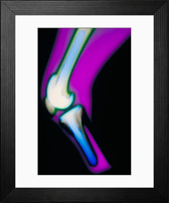 Framed Print : X-ray of knee replacement of a 38 year old female Framed Print : X-ray of knee replacement of a 38 year old female