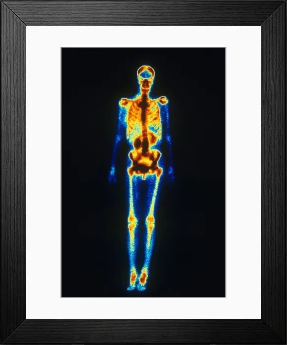 Framed Print : Normal Bone Scan