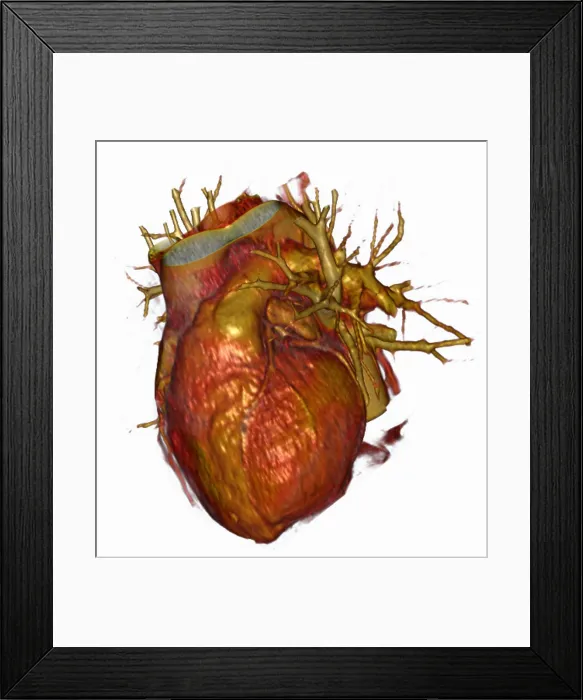 Framed Print : 3D CT Scan of Heart