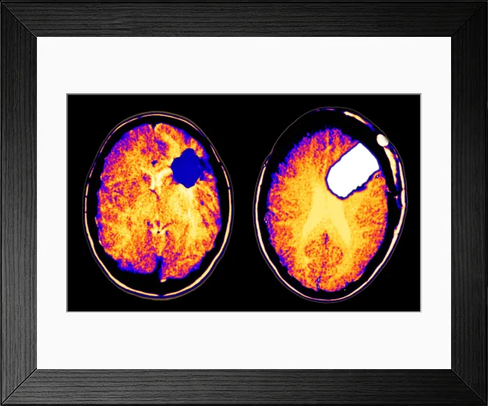 Framed Print : CT scan of brain glioma and tumor removal Framed Print : CT scan of brain glioma and tumor removal