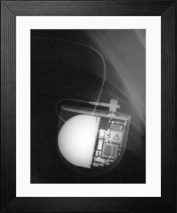 Framed Print : Pacemaker. Color enhanced x-ray of a pacemaker placed in a Bolivian patient Framed Print : Pacemaker. Color enhanced x-ray of a pacemaker placed in a Bolivian patient