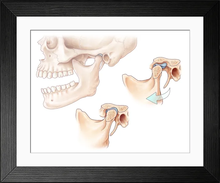 Framed Print : Temporomandibular Joint, Illustration Framed Print : Temporomandibular Joint, Illustration