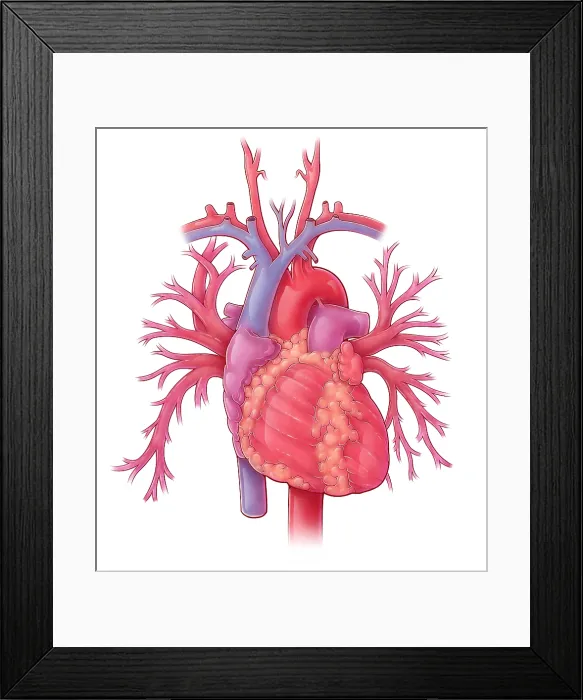 Framed Print : Heart Illustration, with Pulmonary Veins Framed Print : Heart Illustration, with Pulmonary Veins