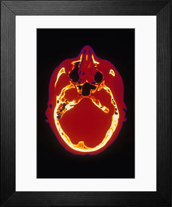 Framed Print : Head, CT Scan Framed Print : Head, CT Scan