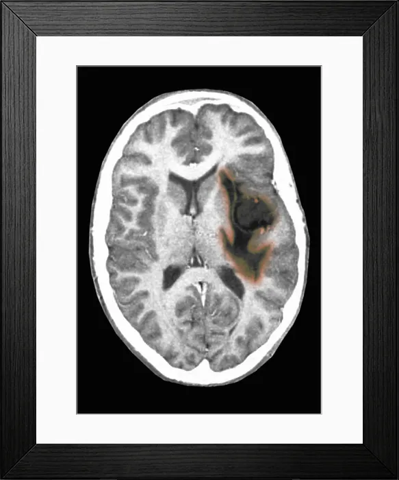 Framed Print : Glioma brain tumor