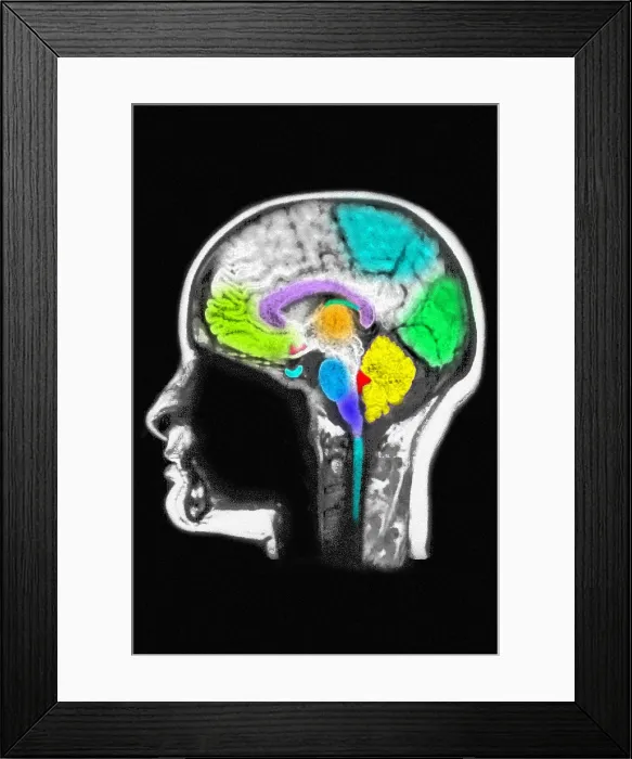 Framed Print : Cerebral MRI