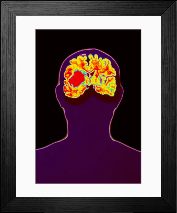 Framed Print : Brain haemorrhage