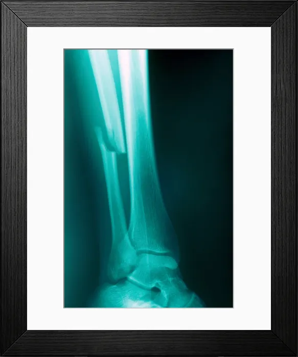 Framed Print : Fractured Fibula, X-ray