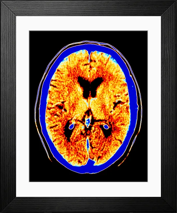 Framed Print : CT scan of section through healthy brain Framed Print : CT scan of section through healthy brain