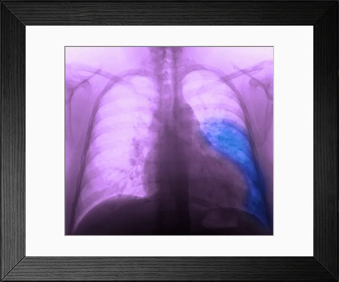 Framed Print : Pneumonia, X Ray Framed Print : Pneumonia, X Ray