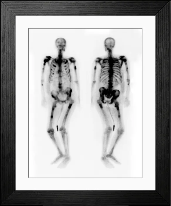 Framed Print : Bone scan showing multiple metastases Framed Print : Bone scan showing multiple metastases