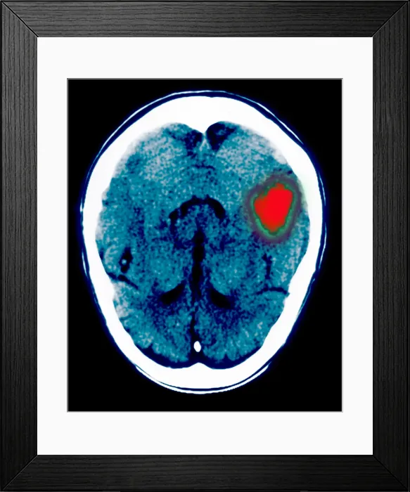 Framed Print : Brain hemorrhage Framed Print : Brain hemorrhage