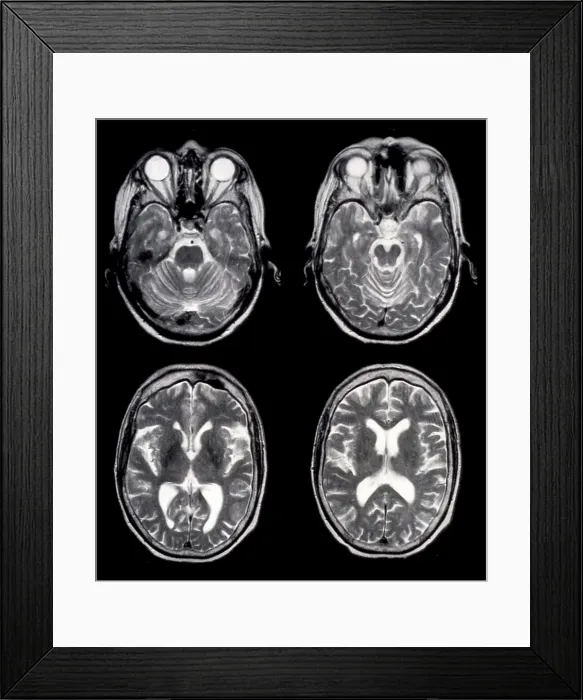 Framed Print : Normal Brain of 65 Year Old Woman, MRI Framed Print : Normal Brain of 65 Year Old Woman, MRI