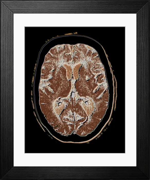 Framed Print : Cerebral CAT scan showing atrophy Framed Print : Cerebral CAT scan showing atrophy