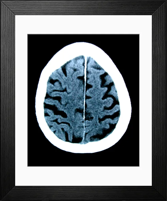 Framed Print : Brain of Alzheimer's Patient, CT Scan