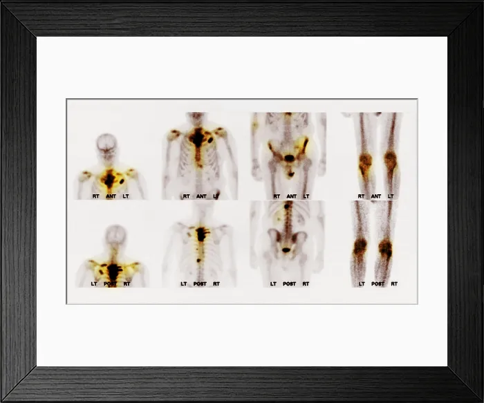 Framed Print : Bone scan showing multiple metastases Framed Print : Bone scan showing multiple metastases