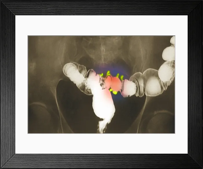 Framed Print : Colon x-ray with barium contrast Framed Print : Colon x-ray with barium contrast