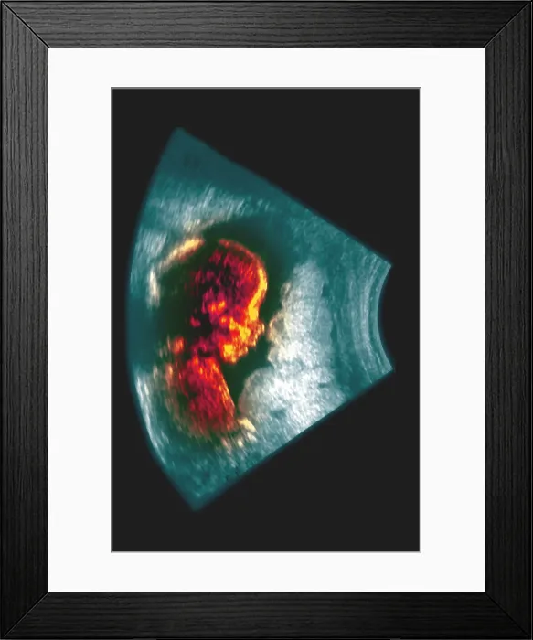 Framed Print : Ultrasound of a 5 month old fetus Framed Print : Ultrasound of a 5 month old fetus
