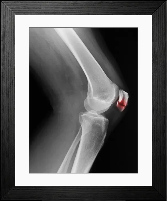 Framed Print : Patellar Fracture X-Ray Framed Print : Patellar Fracture X-Ray