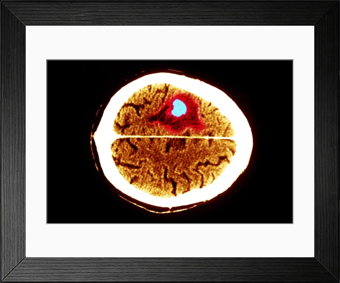Framed Print : Brain edema Framed Print : Brain edema