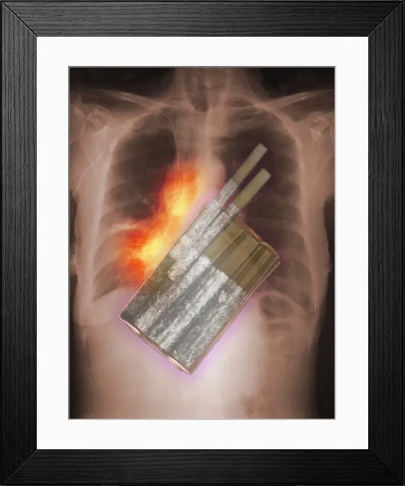 Framed Print : Cigarettes and Lung Cancer Framed Print : Cigarettes and Lung Cancer