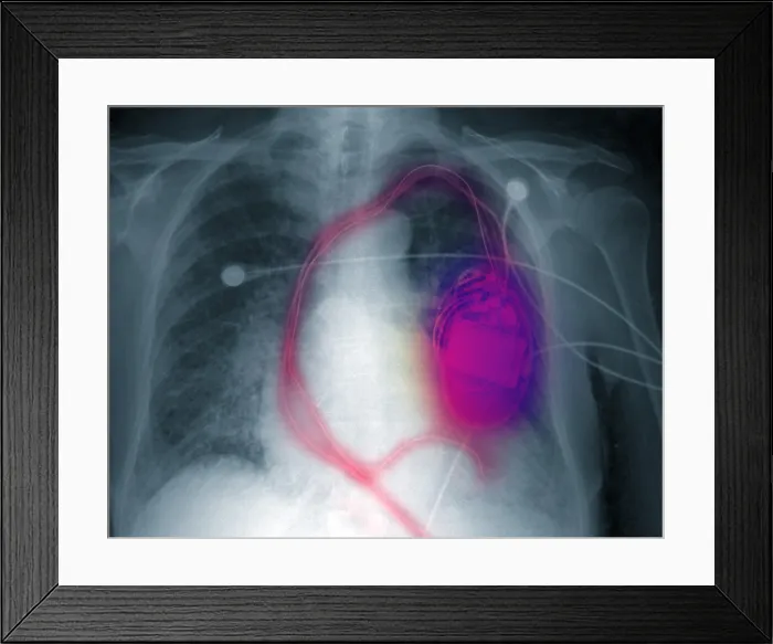 Framed Print : Pacemaker Defibrillator Framed Print : Pacemaker Defibrillator