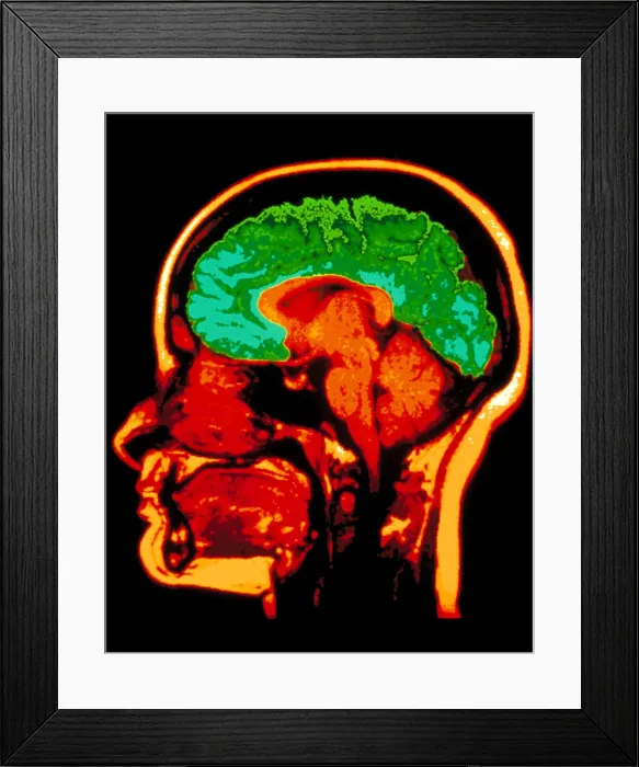 Framed Print : MRI brain scan Framed Print : MRI brain scan
