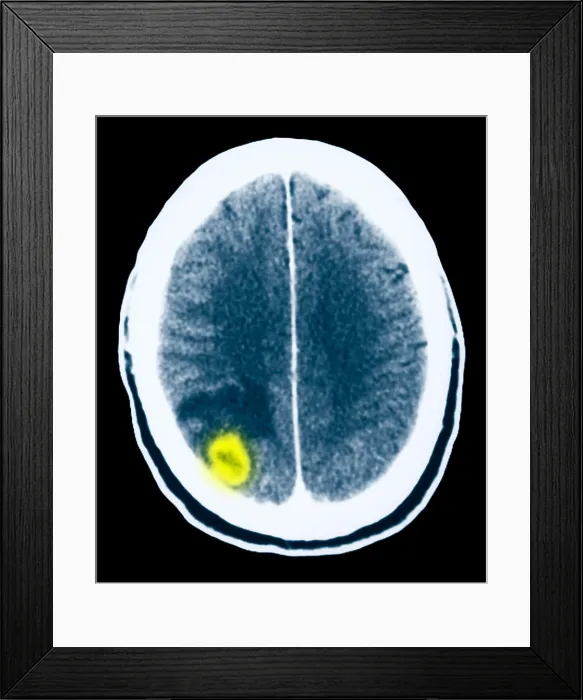Framed Print : Toxoplasmosis of the Brain