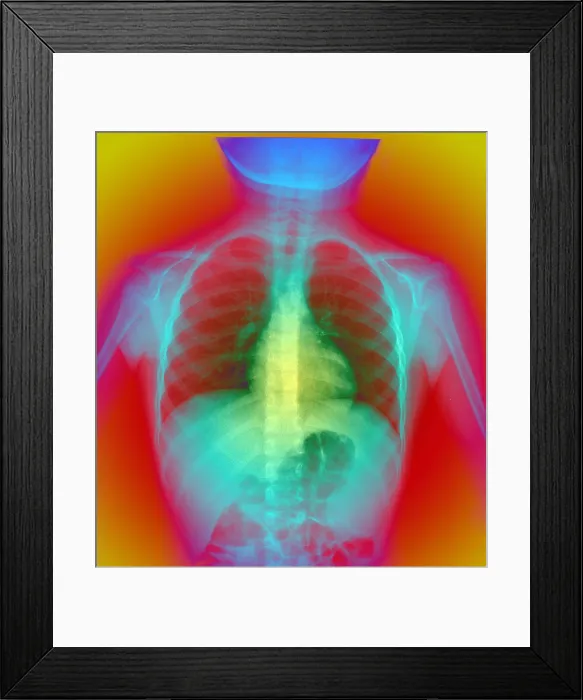 Framed Print : X-ray of chest Framed Print : X-ray of chest