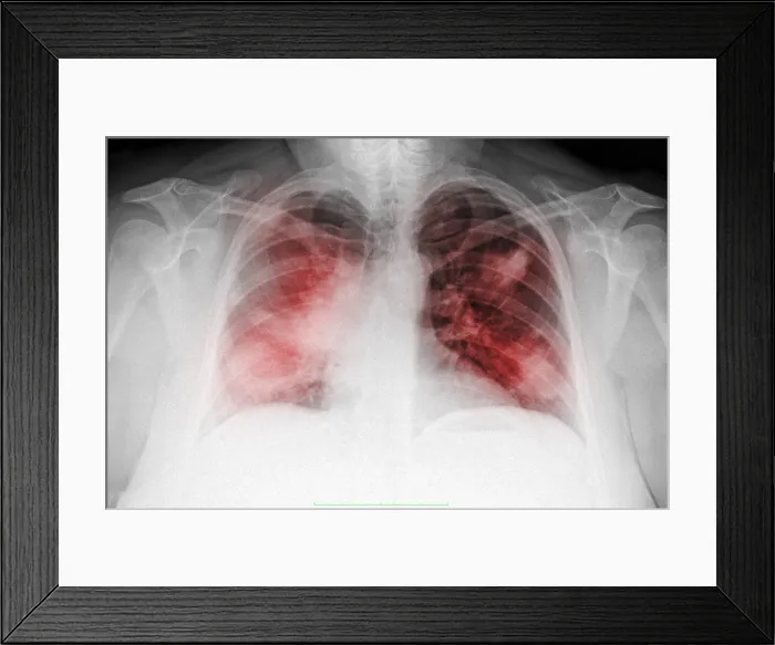 Framed Print : Atypical Pneumonia in Smoker, X-ray Framed Print : Atypical Pneumonia in Smoker, X-ray
