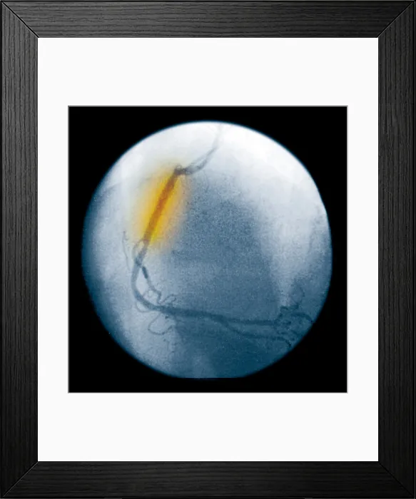 Framed Print : Angiogram of an opened coronary artery Framed Print : Angiogram of an opened coronary artery