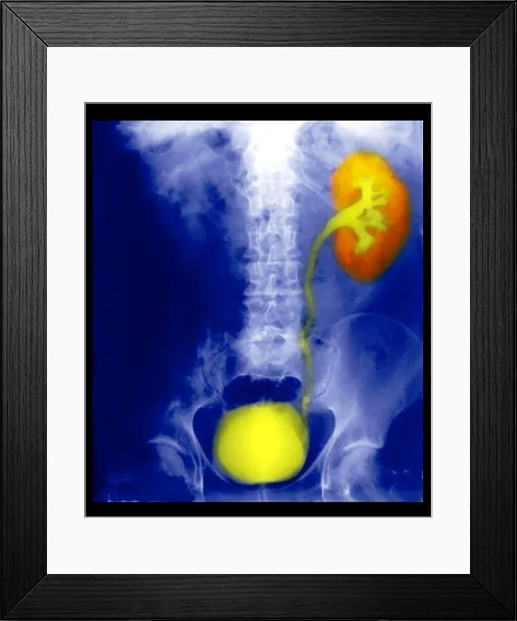 Framed Print : Renal Colic