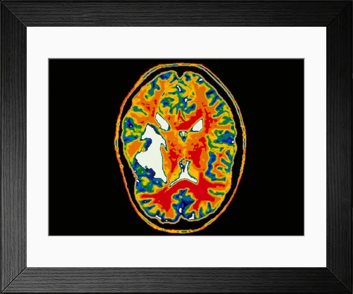 Framed Print : Brain tumor Framed Print : Brain tumor