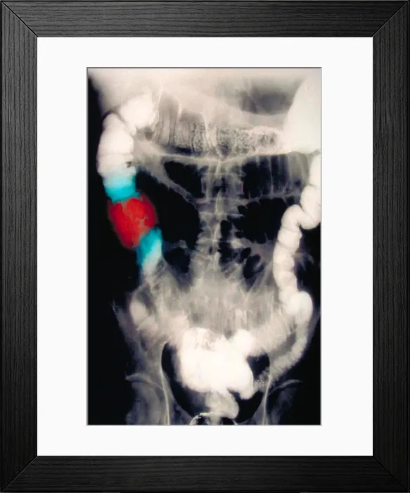 Framed Print : Abdomen X-Ray of colon cancer Framed Print : Abdomen X-Ray of colon cancer
