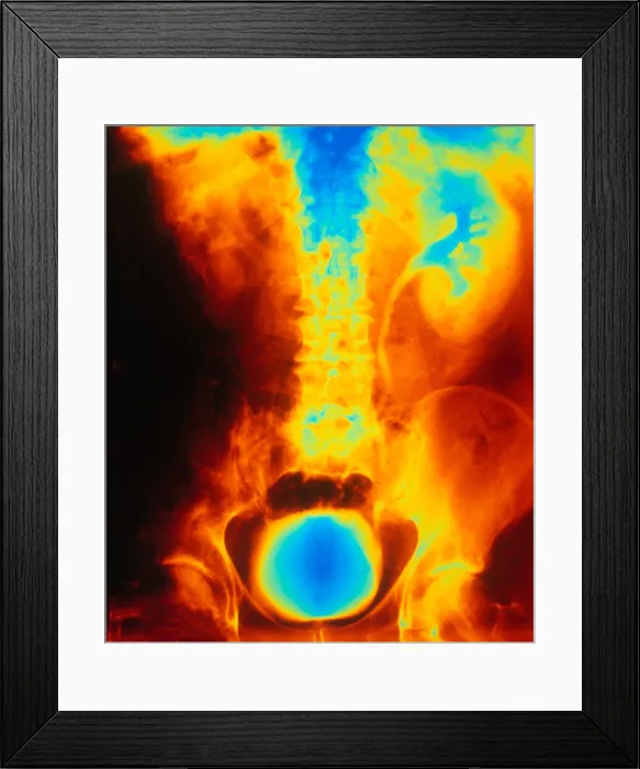 Framed Print : Blocked, Dilated Uterer (Kidney Stone)