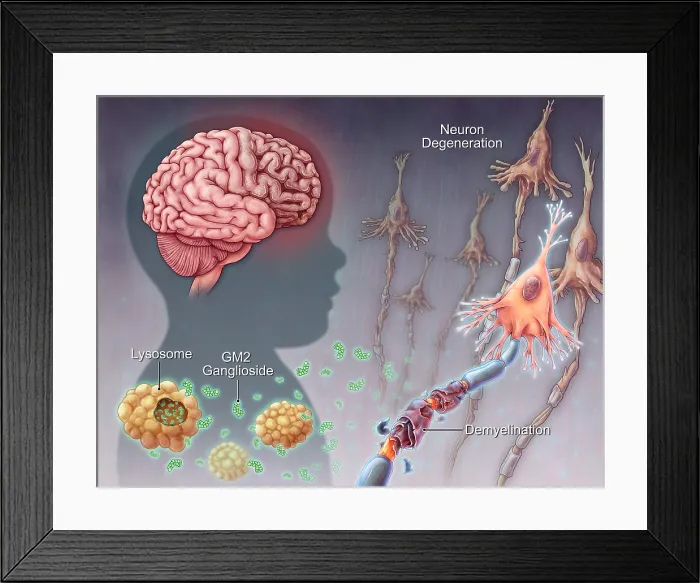 Framed Print : Tay-sachs Disease, illustration
