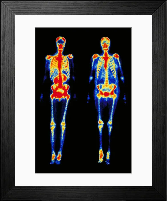 Framed Print : Bone scans Framed Print : Bone scans