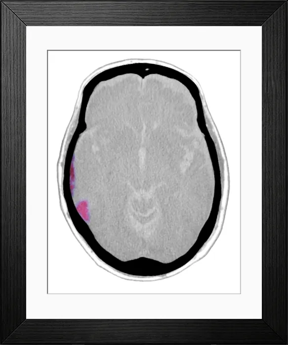 Framed Print : Subdural Hematoma, CT Scan Framed Print : Subdural Hematoma, CT Scan
