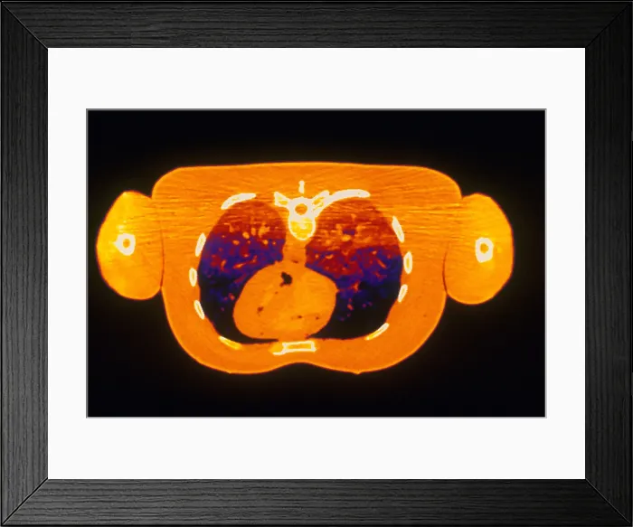 Framed Print : Chest & Heart, CT Scan Framed Print : Chest & Heart, CT Scan