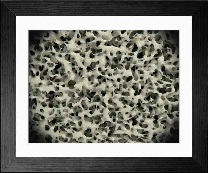 Framed Print : Osteoporosis, osteoporotic bone tissue, illustration