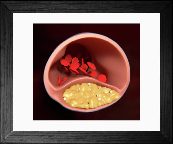 Framed Print : Atherosclerosis, artwork Framed Print : Atherosclerosis, artwork