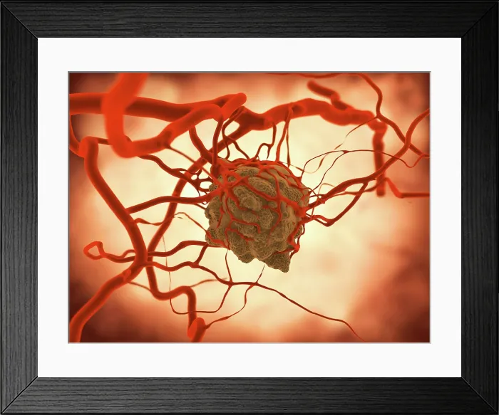Framed Print : Tumor, artwork Framed Print : Tumor, artwork
