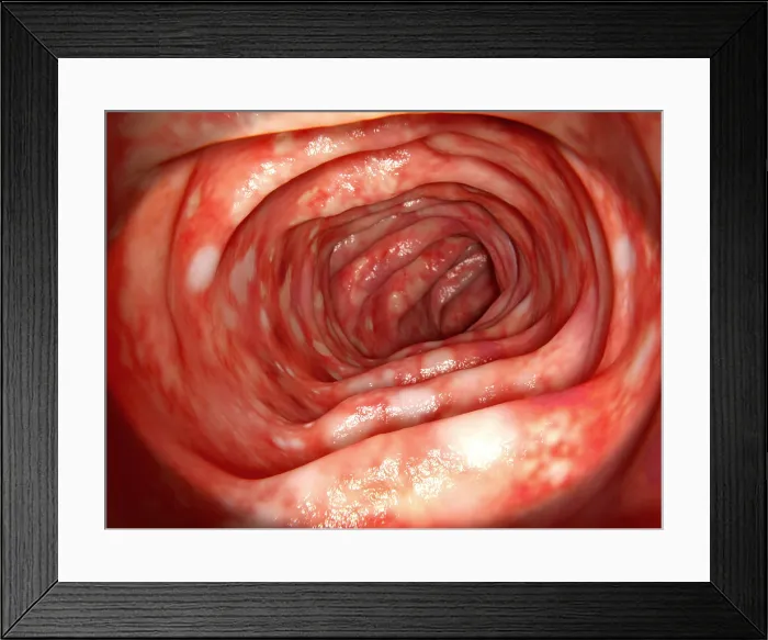 Framed Print : Human colon affected by ulcerative colitis Framed Print : Human colon affected by ulcerative colitis