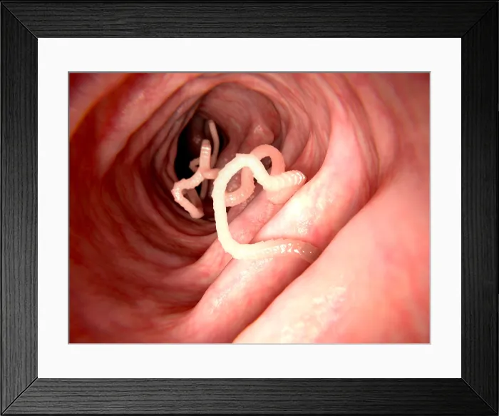 Framed Print : Tapeworm in human intestine Framed Print : Tapeworm in human intestine